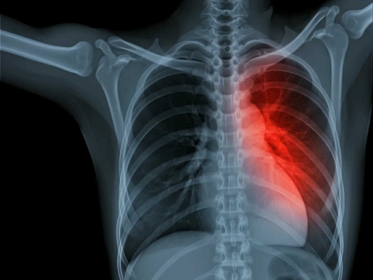 Röntgenbild der Lungen einer Katze mit Asthma zeigt verengte Atemwege.